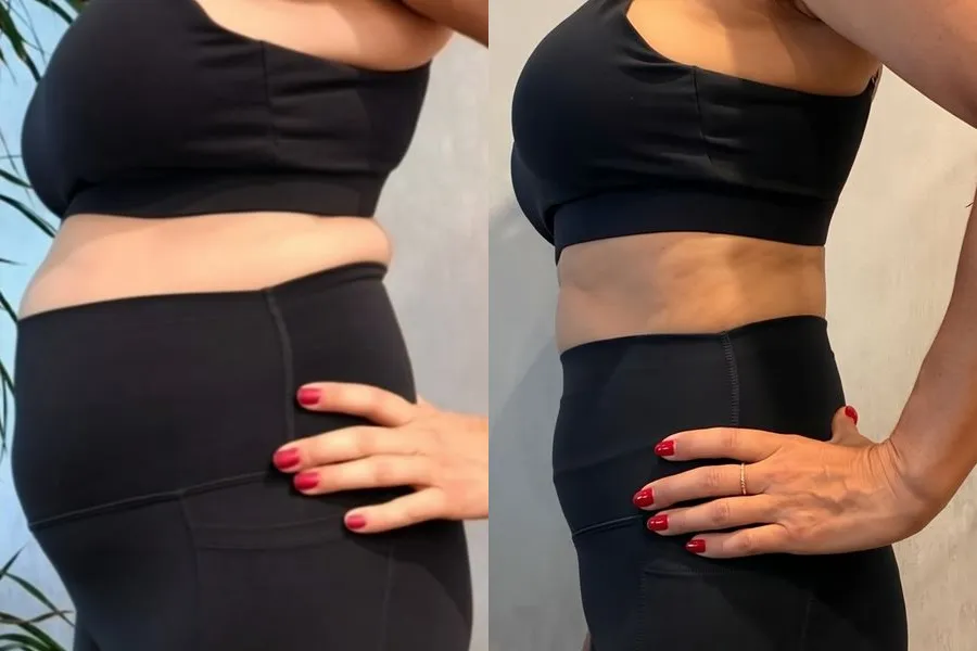 Antes e depois de paciente no acompanhamento de emagrecimento, caso 5
