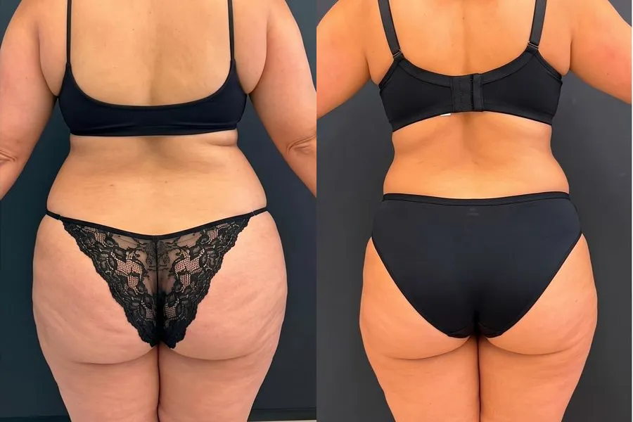 Antes e depois de paciente no acompanhamento de emagrecimento, caso 2