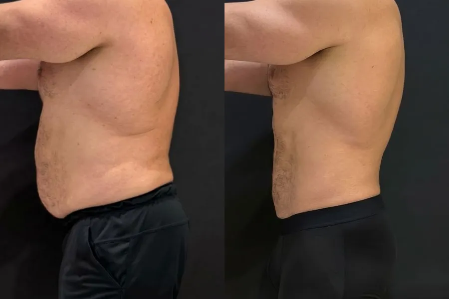 Antes e depois de paciente no emagrecimento com acompanhamento médico da Dra. Isabela Bertoglio, caso 1