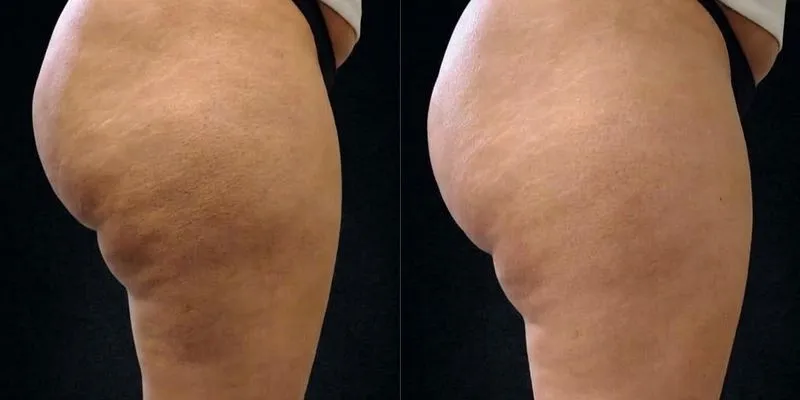 Antes e depois com Unyque Pro - Glúteo e coxa