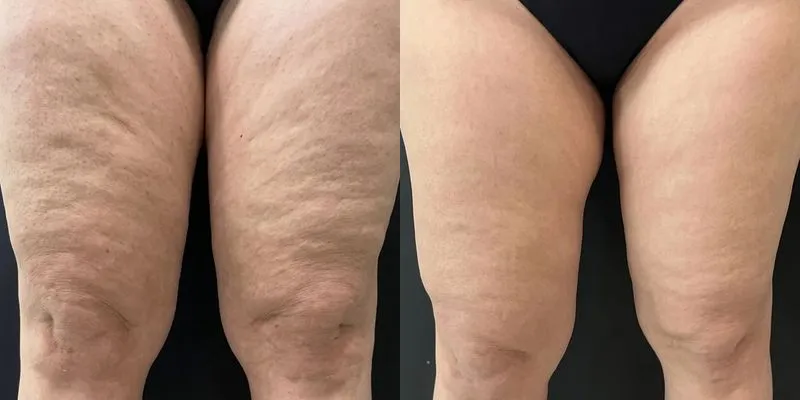 Antes e depois com Unyque Pro - Coxas